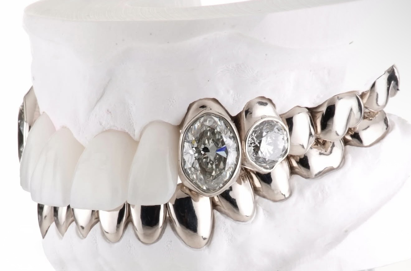 Dental model with white teeth, polished metal crowns and diamond settings.